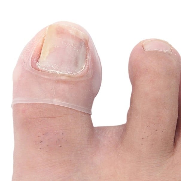 Ferramenta de silicone para correção de unhas encravadas nos pés Tratamento invisível de unhas encravadas 2 pcs 2,8 x 2 cm 1