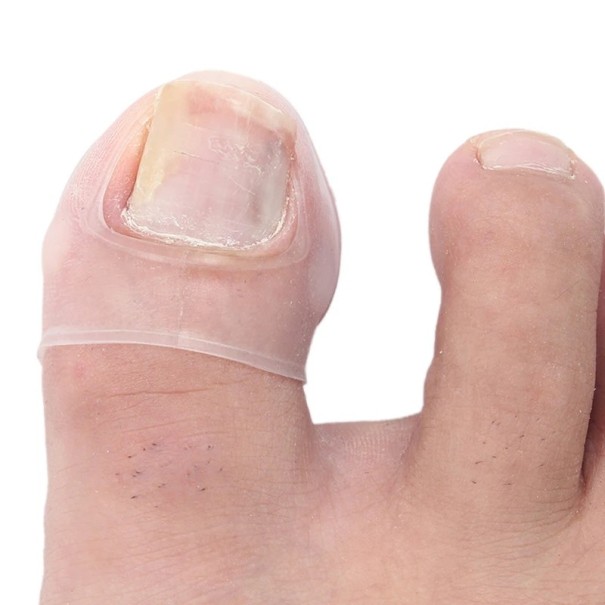 Silikoneværktøj til korrektion af nedgroet tånegl - Behandling af usynlig nedgroet tånegl - Transparente ærmer til nedgroet tånegl - 2 stk. 2,8 x 2 cm 1
