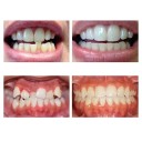 3 phases de gouttières dentaires pour adultes Correcteur orthodontique transparent 3 duretés pour correction des dents et amélioration du sourire 4