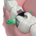 Conjunto de 40 unidades de cunhas interdentárias ES Extra pequeno Amarelo mini cunha de compósito 270° cunhas de silicone selantes Material adaptativo para restauração dentária 4