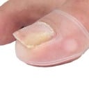 Herramienta de silicona para la corrección de uñas encarnadas en los pies Tratamiento invisible de uñas encarnadas 2 unidades 2,8 x 2 cm 2