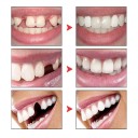 Kit de réparation dentaire pour dent manquante ou cassée Gel adhésif dentaire Réparation dentaire d'une dent temporaire Matériau dentaire de remplacement 3 pinces dentaires 2