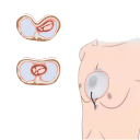 Přísavka na nálevkovitý hrudník s tlakoměrem a balonkem Velikost M Podtlaková korekce měkký silikon bílá na pectus excavatum 4