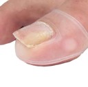 Silikoneværktøj til korrektion af nedgroet tånegl - Behandling af usynlig nedgroet tånegl - Transparente ærmer til nedgroet tånegl - 2 stk. 2,8 x 2 cm 2