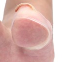 Silikoneværktøj til korrektion af nedgroet tånegl - Behandling af usynlig nedgroet tånegl - Transparente ærmer til nedgroet tånegl - 2 stk. 2,8 x 2 cm 4