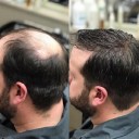 Uienspray voor snelle haargroei 30 ml 3