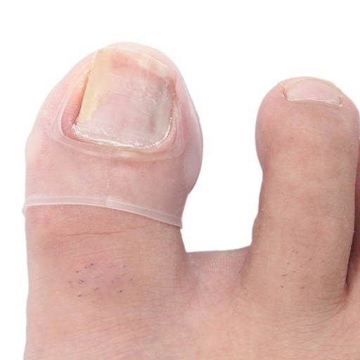Instrument de corectare a unghiilor încarnate din silicon Tratament invizibil pentru unghiile încarnate de la picior Capace transparente pentru unghiile încarnate 2 buc 2,8x2 cm